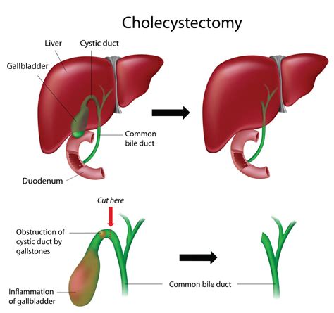 b4il3e leaks|Gallbladder removal